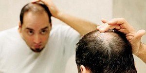 Causes and Remedies to prevent baldness