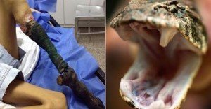 Horrific Snake Bite Causes Girl’s Leg to Shrivel and Turn Black after Venom Causes Necrosis!!!